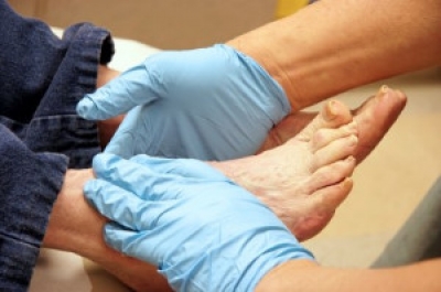 Progression of Diabetic Foot Problems