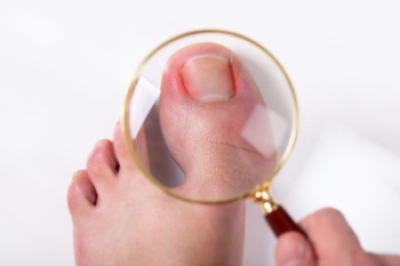 Managing a Stubborn Ingrown Toenail
