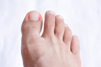 How to Know if You Have an Ingrown Toenail
