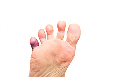 I Think I Broke My Pinky Toe